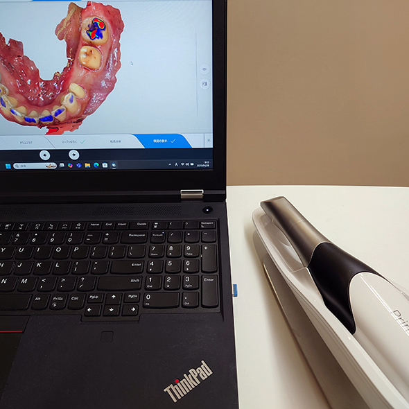 口腔内スキャナー